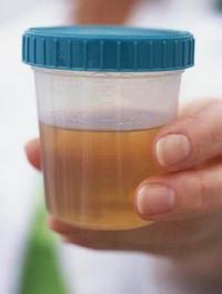 Dacă se găsește o proteină în urină, ce înseamnă aceasta?