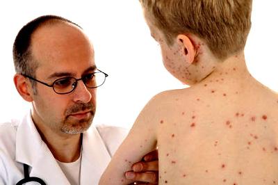 Cum poate copilul să dezvolte varicela și cum să o tratăm?