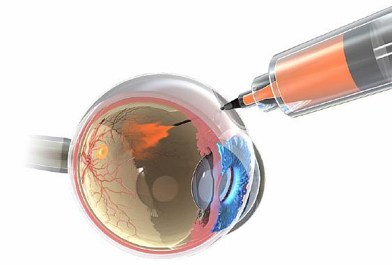 Degenerarea maculară a retinei: cauze și tratament