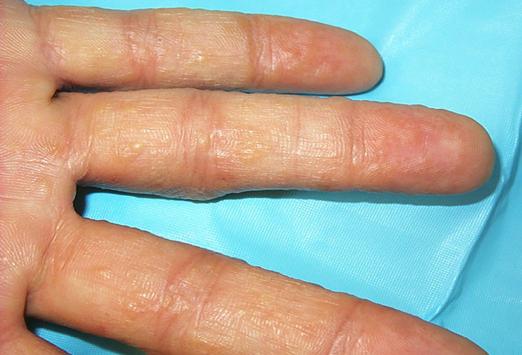 Apiculii vezici pe degete: simptomatologie și tratament